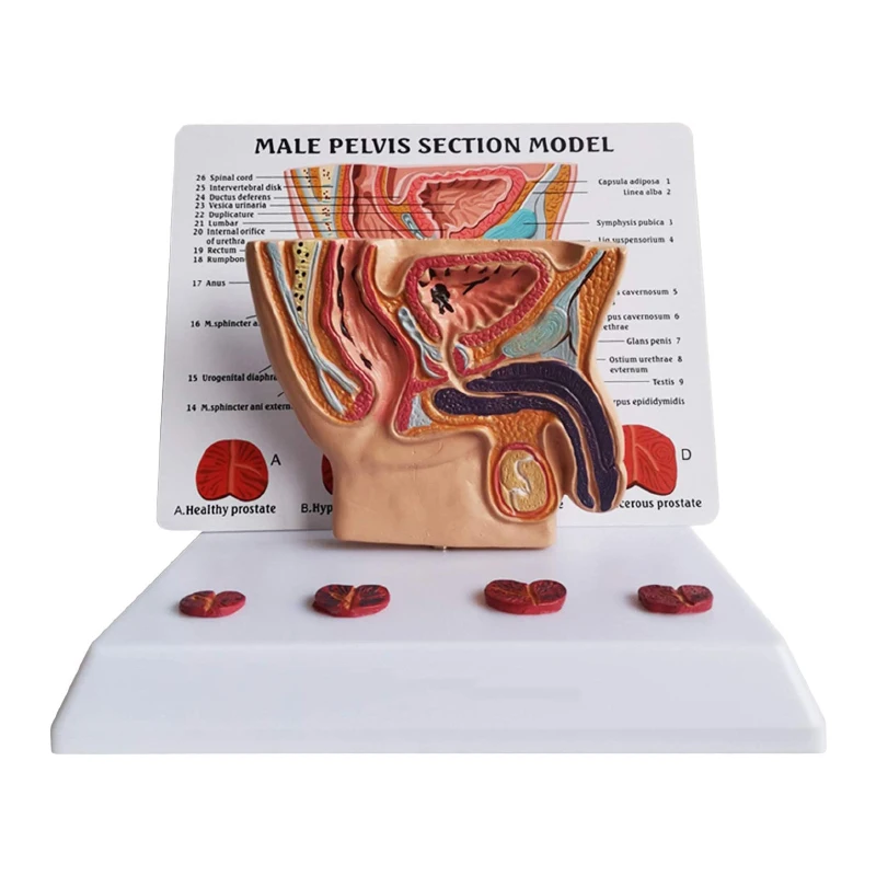 

Human male abdominal cavity bladder prostate health morbidity comparison medical teaching doctor-patient explanation model