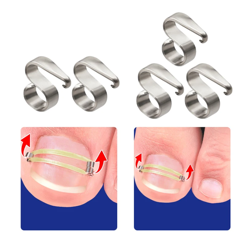 Корректор для вросших ногтей профессиональный инструмент коррекции педикюра