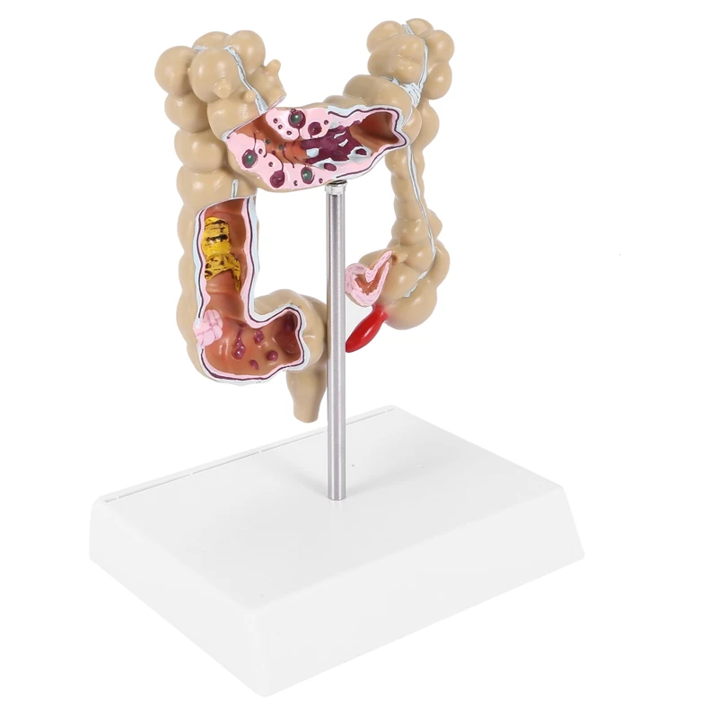 Colorectal Lesion Model Human Colon Large Intestine Pathological Diseases Mrganizer Anatomy |