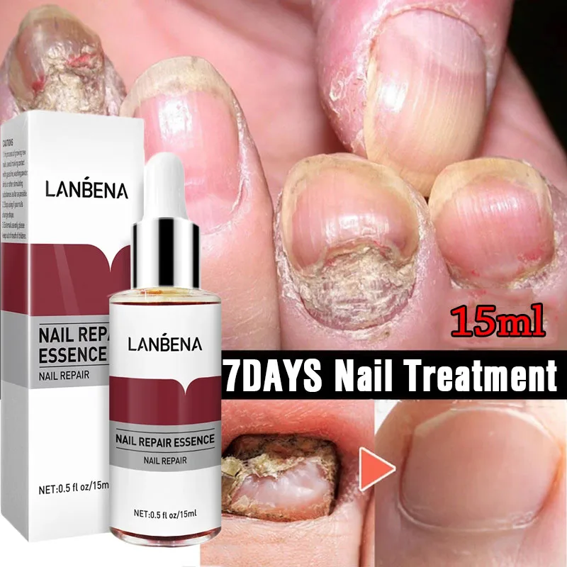 

Nail Fungus Treatment Essence Serum Care Hand and Foot Care Removal Repair Gel Anti-infective Paronychia Onychomycosis