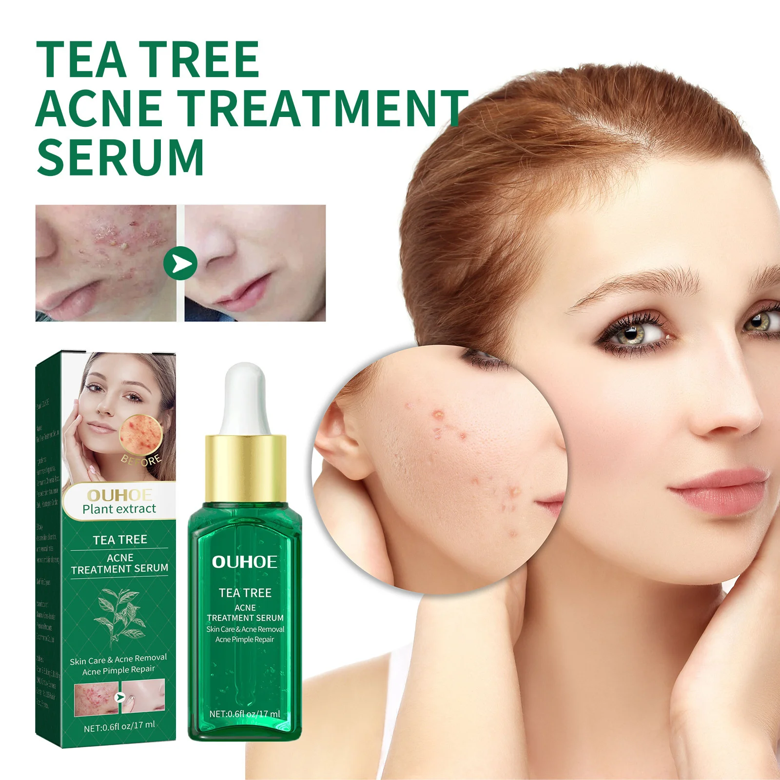 

Tea Tree Acne Treatment Serum Anti-acne Fade Acne Scars Essence Oil Control Shrink Pores Moisturizing Remove Blackhead Skin Care