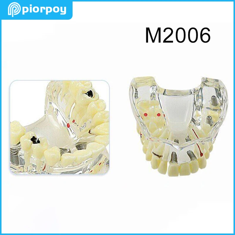 Стоматологические кариесы, бриллиантовая модель для обучения стоматологии, демонстрационные Обучающие товары для студентов M2006