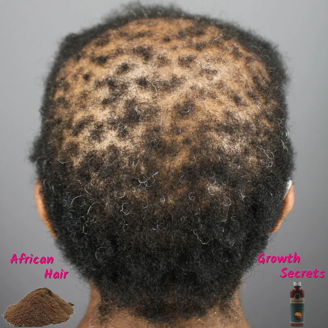 

100% Natural HAIR REGROWTH Products for EXTREME Hair Growth Stop Alopecia and Hair Thinning with This Powerful Treatment