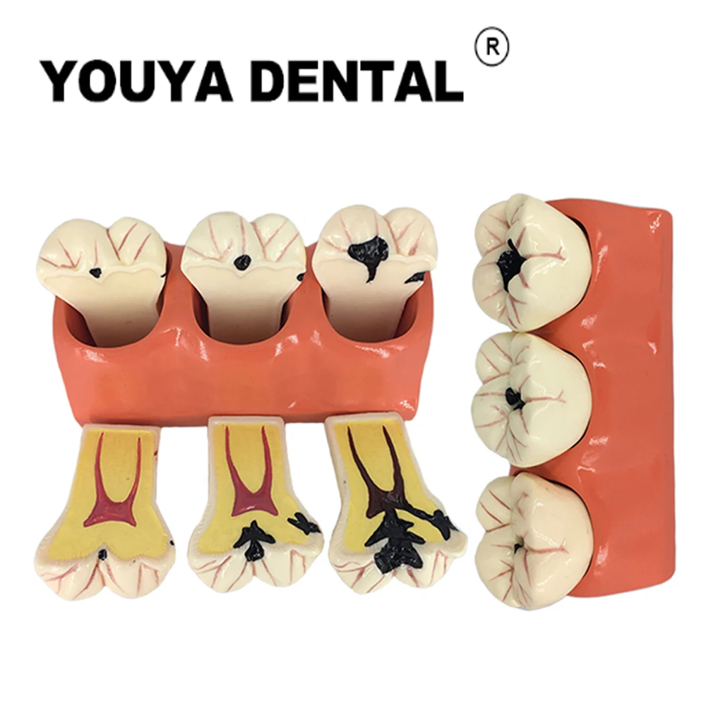 

Стоматологическая модель 4-кратная кариеса, развивающая обучающая модель для стоматологов, студентов, изучающих медицину, стоматологию, то...