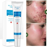 30ml acne removal cream anti acne treatment oil control shrink pores moisturizing whitening acne scars pimple marks face cream