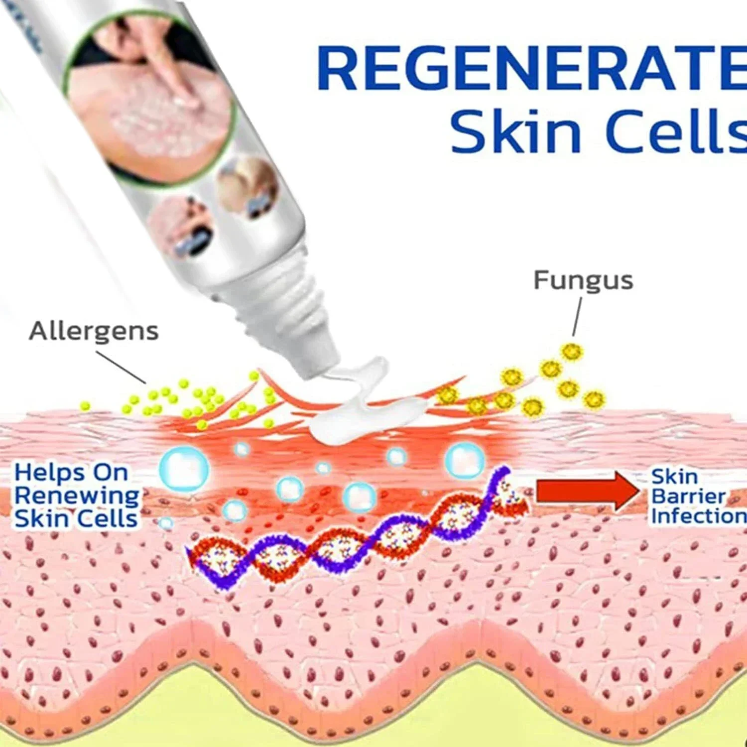 Антибактериальная мазь для лечения псориаза тела и бедра