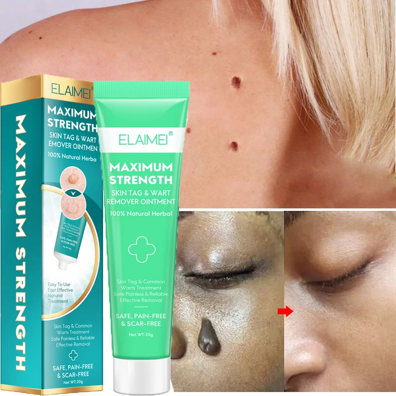 Skin Tag Remover Cream Painless Wart Spot Nevus Mole Skin Face Wart Tag Freckle Treatment Removal Gel Men Women Essential Oil