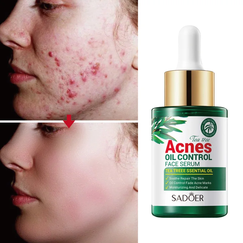 

Tea Tree Serum Acne Treatment Facial Essence Anti-acne Oil Control Herbal Pimple Scar Removal Shrink Pores Moisturize Skin Care