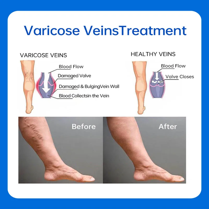 

Highly effective varicose vein relief cream ointment for varicose vein relief vasculitis phlebitis spider pain treatment