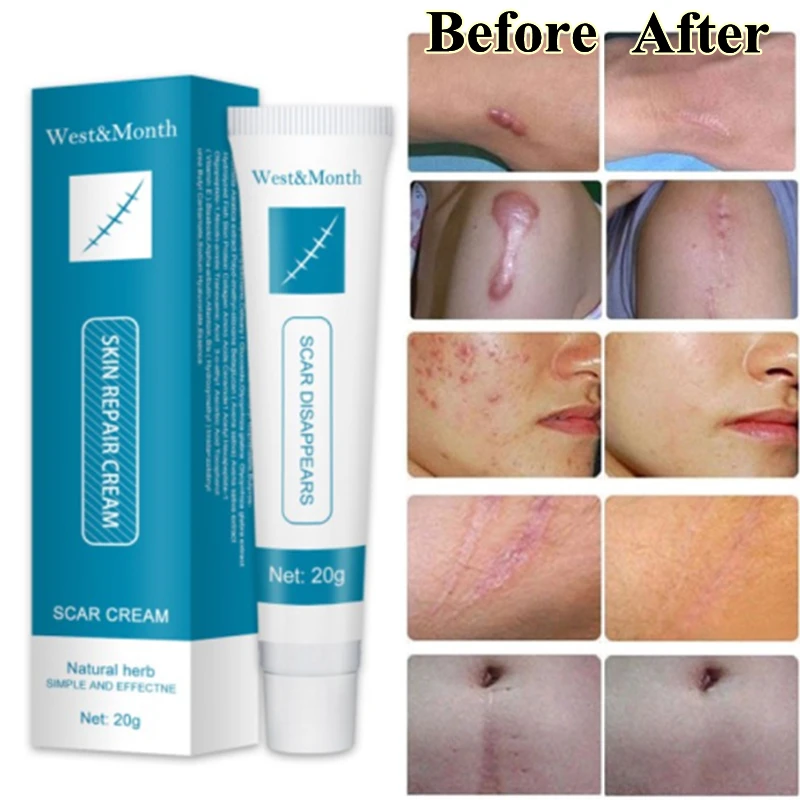 

Herbal Scar Removal Cream Gel Stretch Marks Remove Acne Spots Burn Surgical Scars Treatment Smooth Whitening Face Body Skin Care