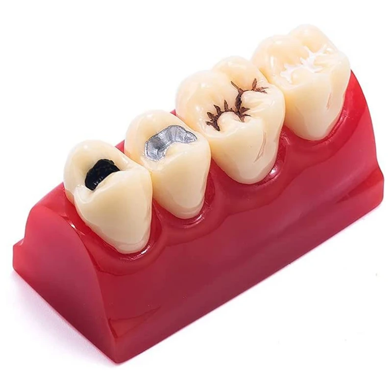 

Pathology Teeth Model Sealant Demonstration Tooth Model For Teaching,Displaying, Educating