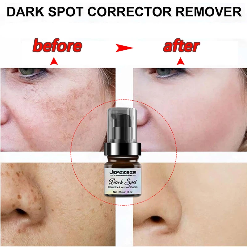 

Whitening Freckle Cream Remove Melasma Acne Spot Pigment Melanin Dark Spots Melasma Remover Moisturize Anti-aging Face Care