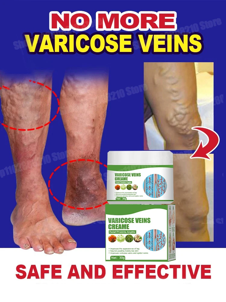 Мазь для лечения варикозного расширения вен мазь от флебита ног-паука снимает