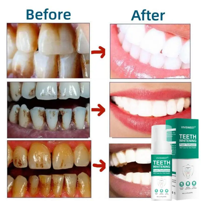 

30ml Teeth Whitening Mousse Dental Care Toothpaste Essence Remove Plaque Tooth Stain Gingival Repair Caries Prevention Oral