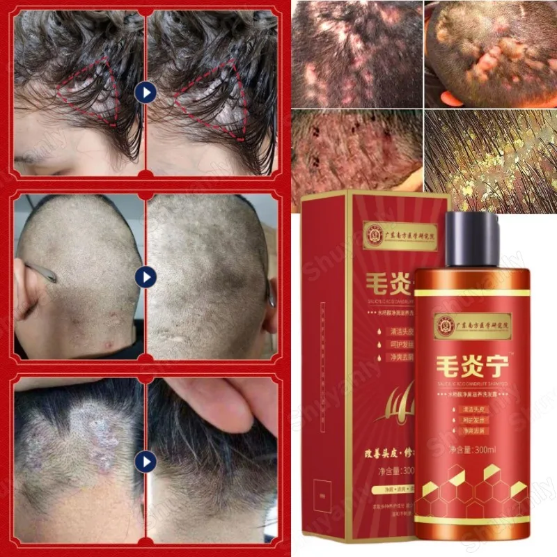Compound Herbal Shampoo Anti Dandruff Dermatitis Relieve Flaking Itching Hair Psoriasis Seborrheic Treatment Dermatitis Eczema