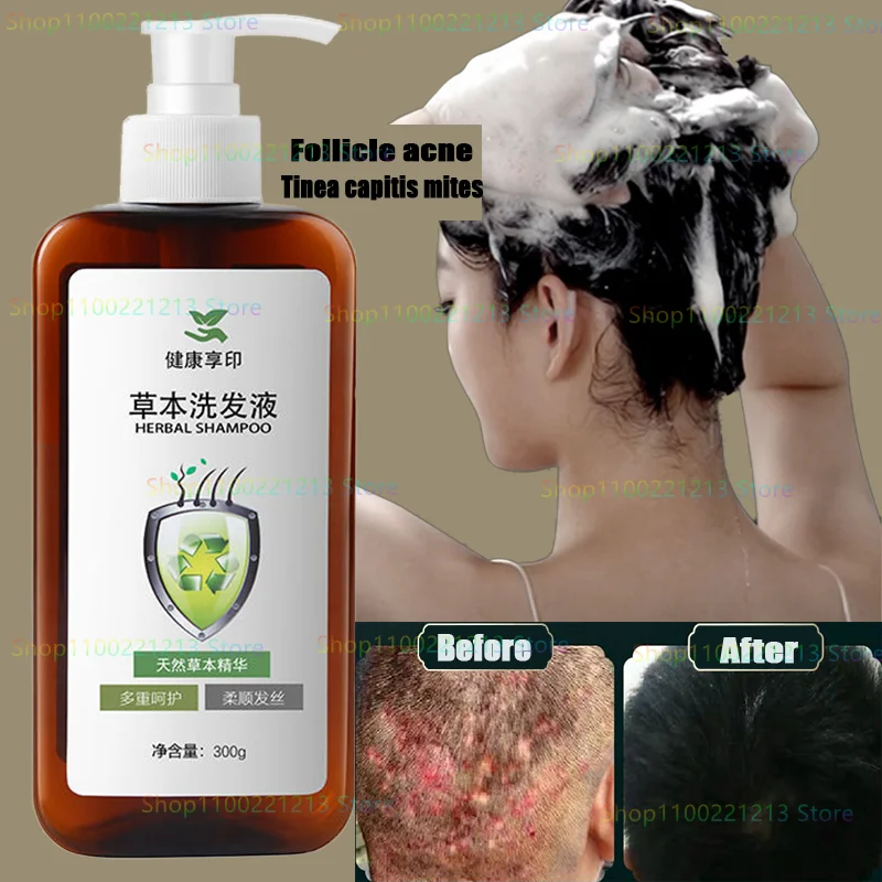 

Dandruff Itching Oil Control Anti-shedding Cleaning Healthy Dermatitis Mite Removal Hair Follicle Repair Shampoo Herbal Formula