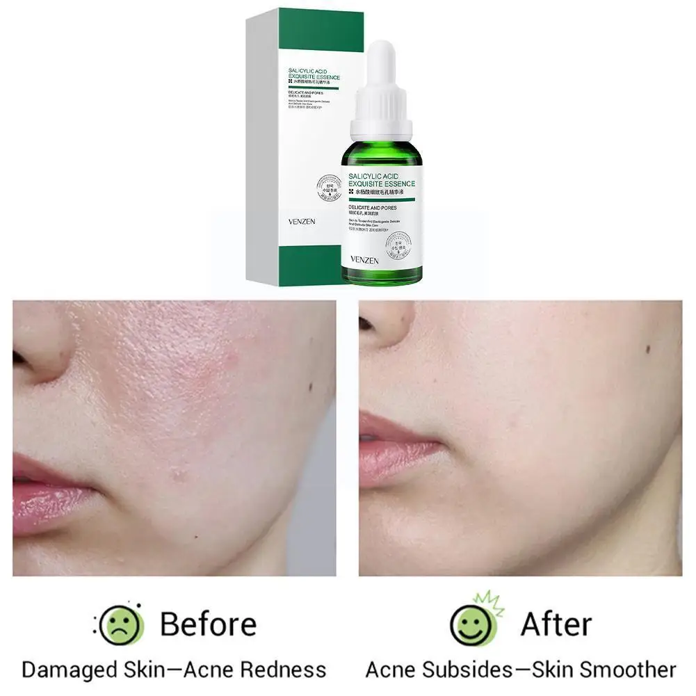 

Salicylic Acid Face Serum Anti-aging Shrink Pore Whitening Skin Dry Cream 30ml Care Essence Moisturizing Face P7e3