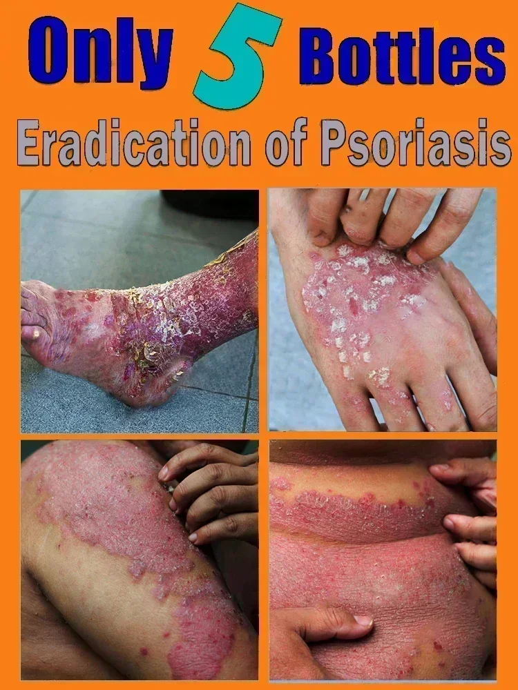 Лучший продукт против дерматита при псориазе и экземе: натуральный растительный