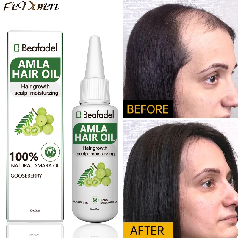 For Hair Growth India Gooseberry Hair Oil Anti Hair Loss Sca