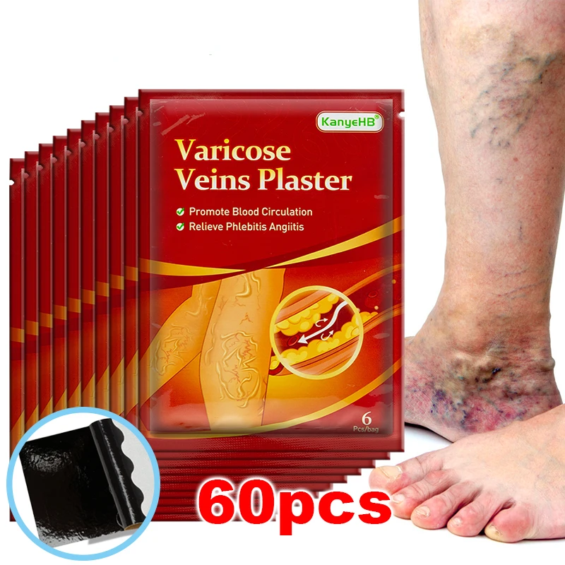 

18/30/42/60pcs Varicose Veins Ointmnet Vasculitis Phlebitis Spider Cream Varicosity Angiitis Removal Herbal Medical Plaster Care