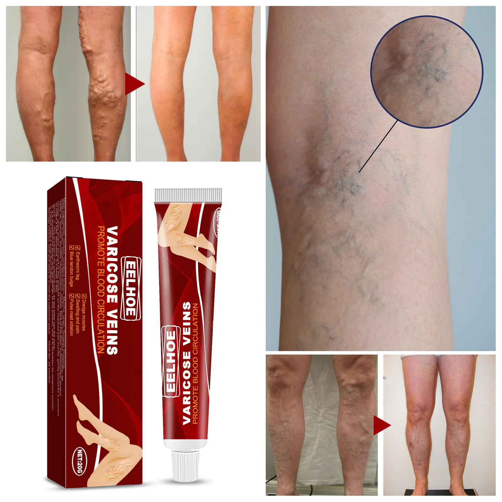 

Varicose Vein Treatment Cream Relieve Tired Legs Dilated Vasculitis Phlebitis Spider Pain Relief Herbal Ointment Body Skin Care