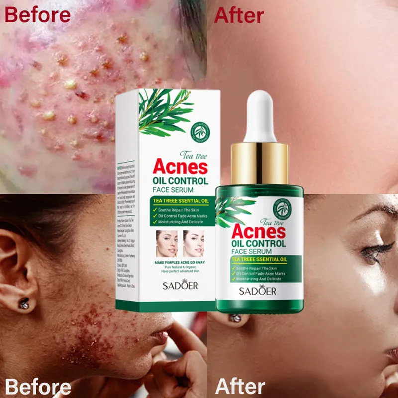 

Acne Treatment Face Serum Salicylic Acid Pimple Scar Blackhead Removal Shrink Pores Oil Control Moisturizing Facial Skin Care