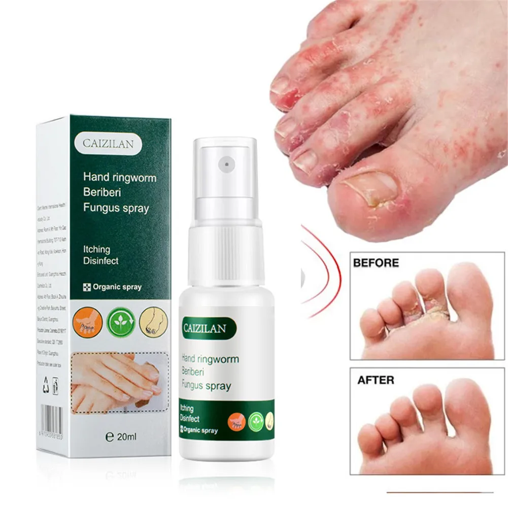 

Foot Anti Fungal Spray Fungal Cream Relieve Beriberi Toe Treatment Gel for Cracked Heel Peeling Blister Repairing Feet Ointment