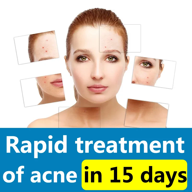 

Effective Acne Removal Cream Treatment Acne Scar Shrink Pores Oil Control Whitening Moisturize Cream Face Gel Skin Care Unisex