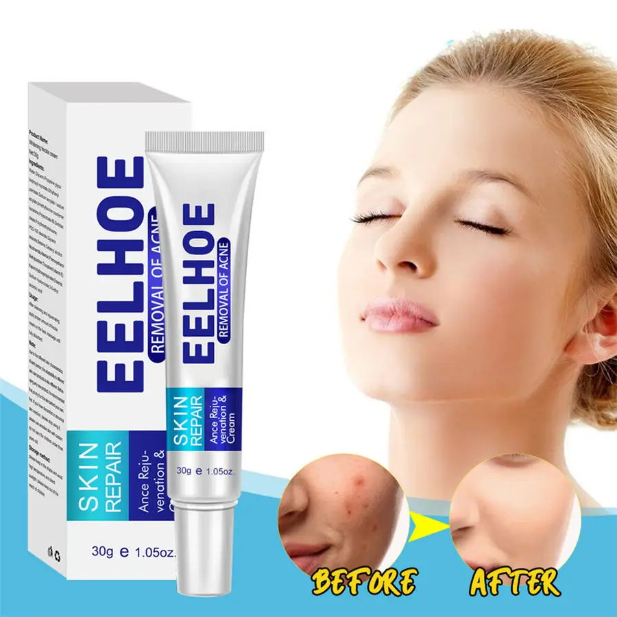 

Acne Removal Anti-acne Treatment Fade Moisturizing And Hydrating Face Cream Oil Shrink Pores Whitening Anti-Acne Face Care
