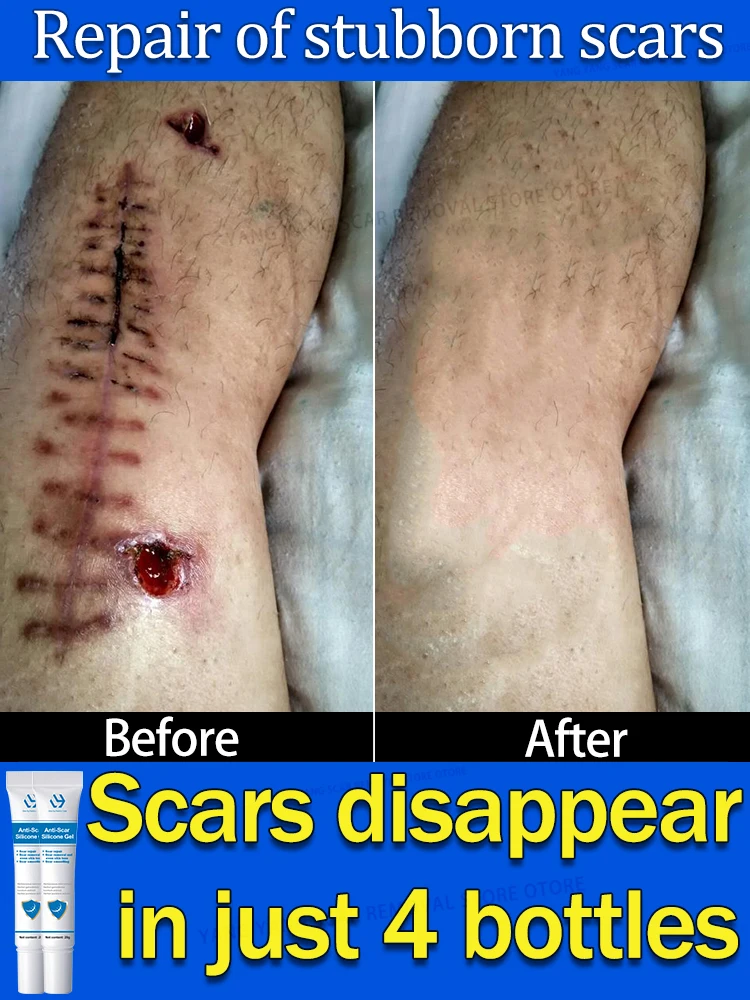 

scar removal cream hyperplastic scars scar gel scar repair burn caesarean section surgical scars scar removal scar bumps