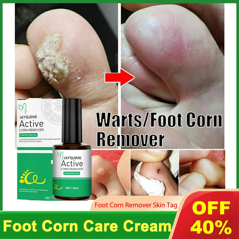 

Effectively Remove Foot Corn Care Cream Remove Foot Calluses Remove Warts Smooth Skin Mild Wart Removal Corns Foot Care Solution