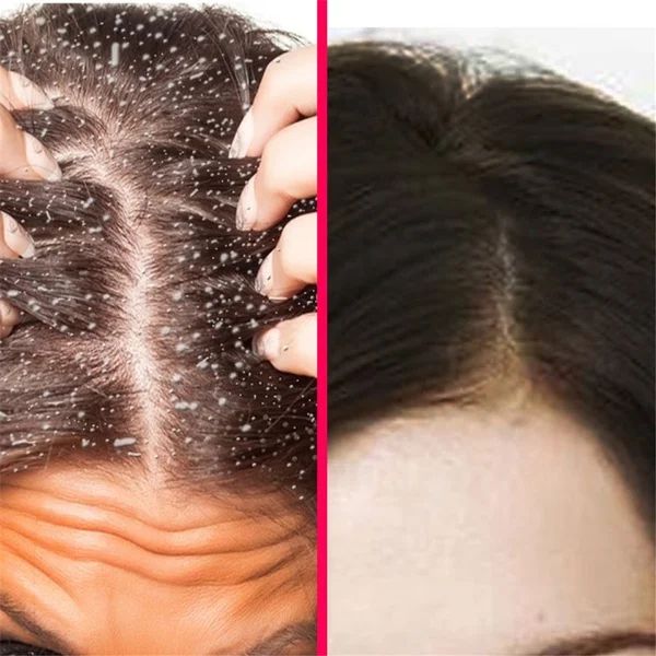 Натуральные эфирные масла против перхоти быстрое избавление от выпадение волос