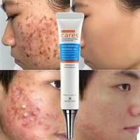 acne removal gel effective treatment acne anti acne shrink pores oil control whitening moisturizing repair skin care