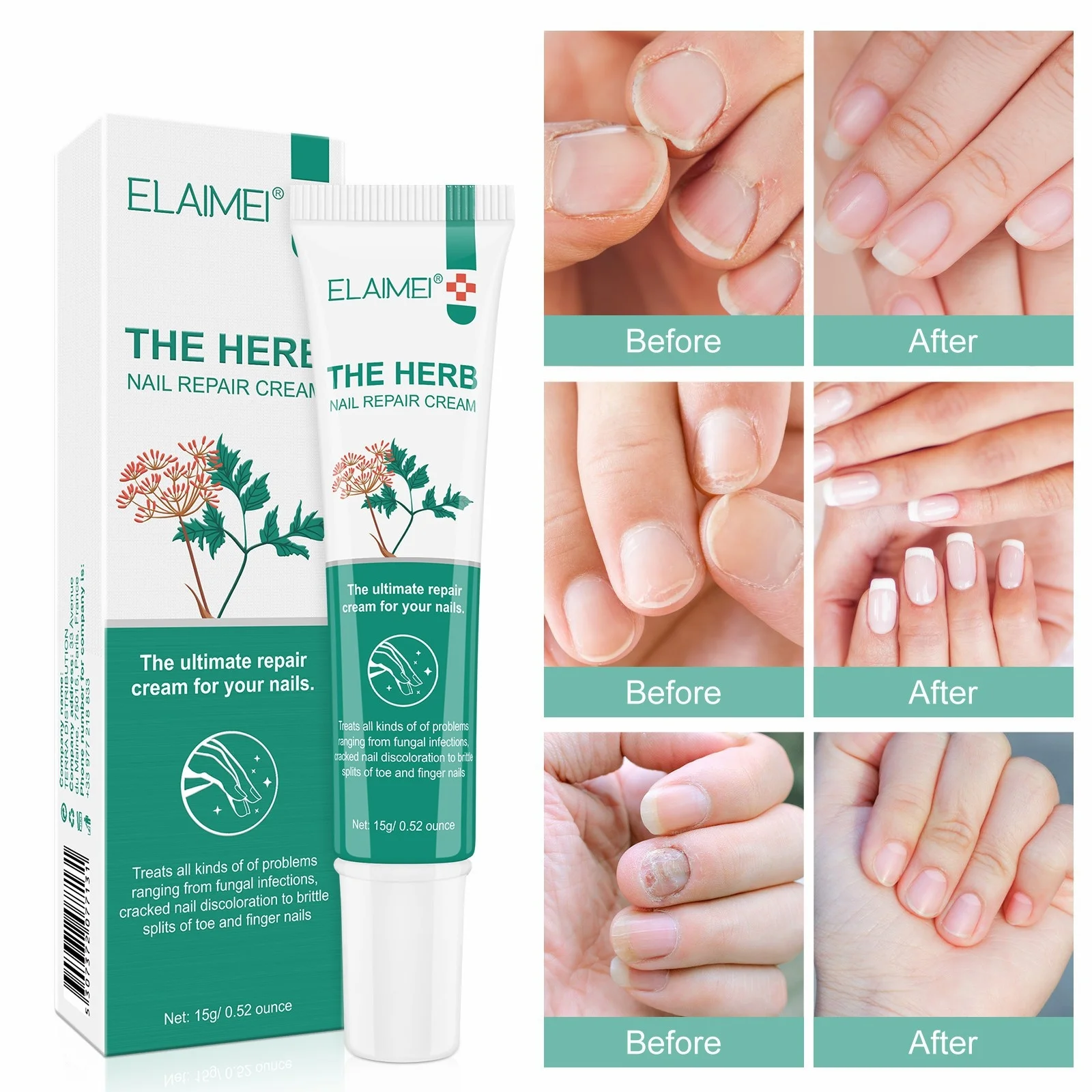 

Herb Fungal Nail Treatment Cream Toenail Fungus Removal Serum Anti Infection Repair Hand Feet Care Gel Paronychia Onychomycosis