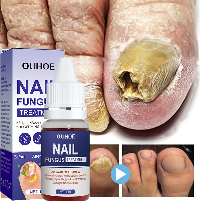 

Nail Fungus Treatments Serum Anti-Infection Onychomycosis Paronychia Tea Tree Repair Essence Toe Fungal Hand Foot Healthy Care