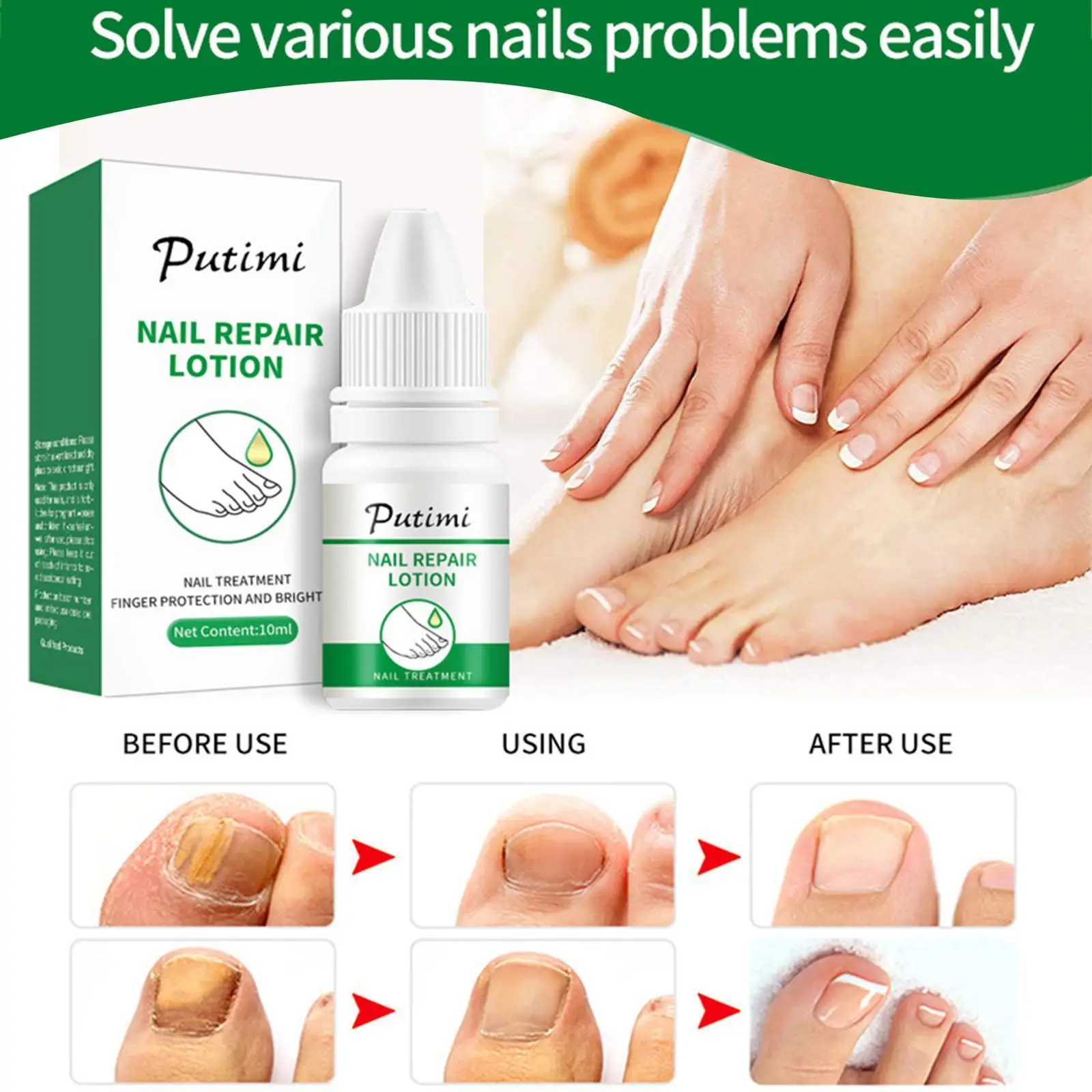 

Nail Fungal Treatment Feet Care Essence Serum Anti Foot Foot Paronychia Onychomycosis Fungus Removal Infection Toenail Care T1I6