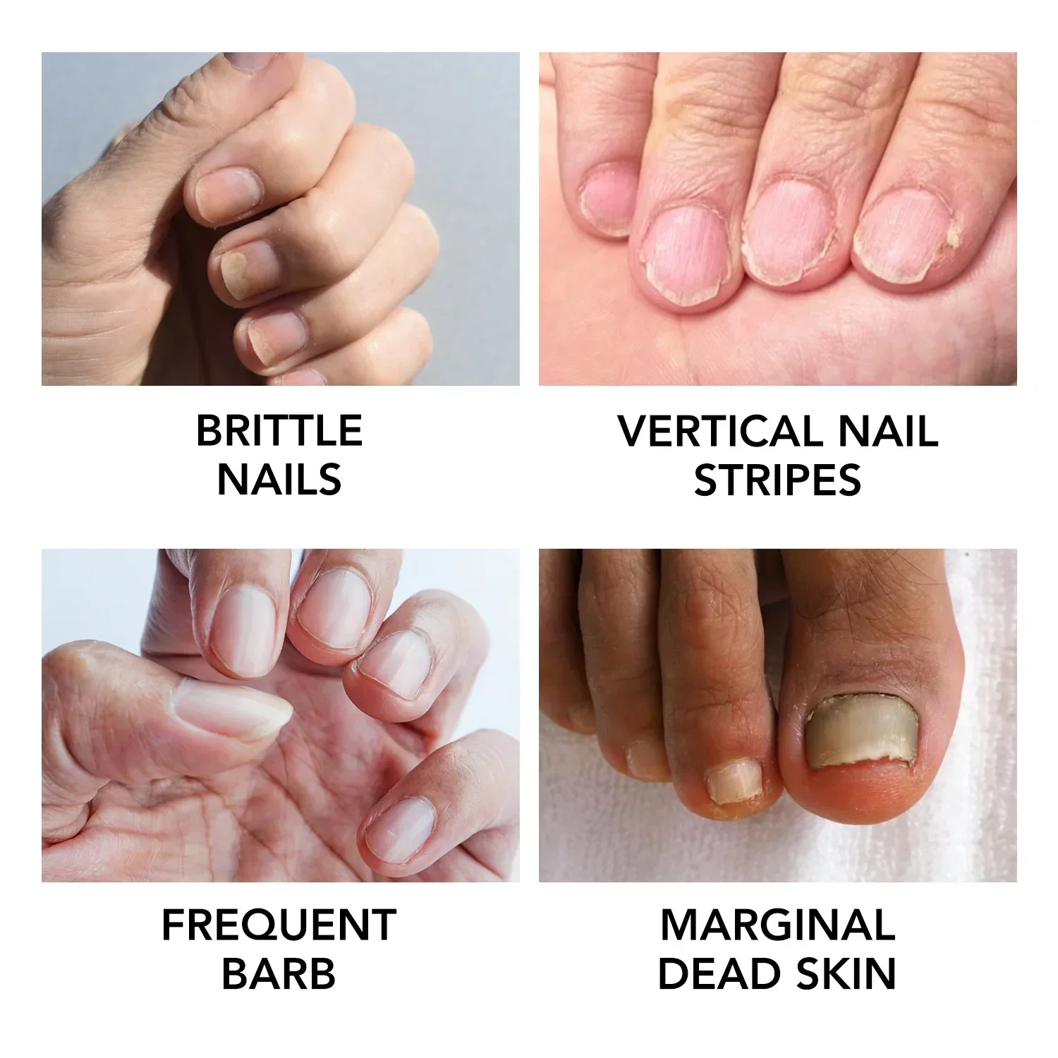 Wzmocnienie paznokci Rozwiązanie odżywcze Naprawa pielęgnacji stóp