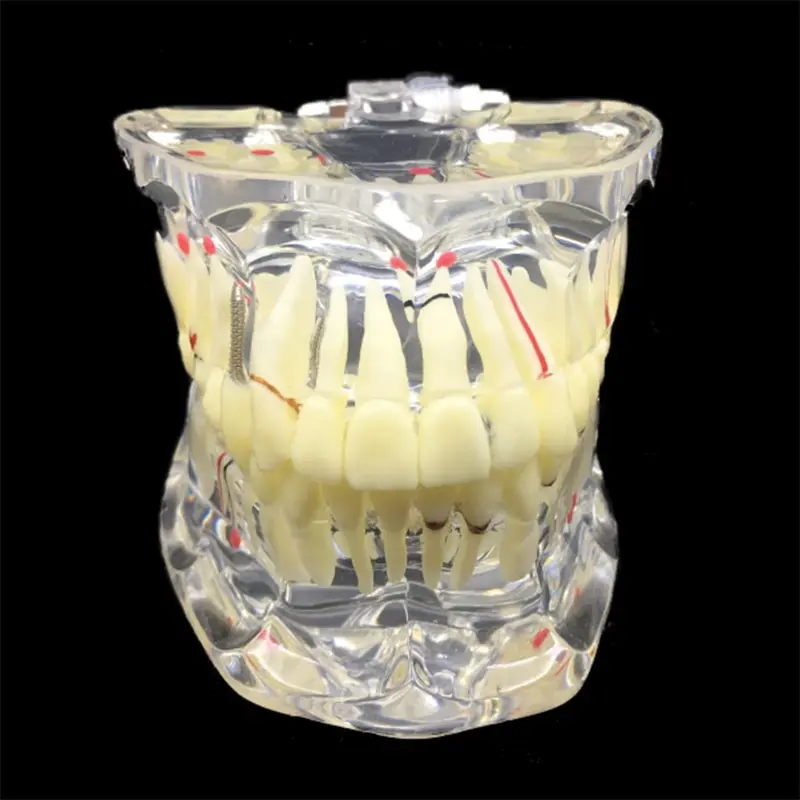 

Dental Transparent Adult Pathological Teeth Display Model Disease Teeth Model Dental Lab Equipment Dentist Teaching Model