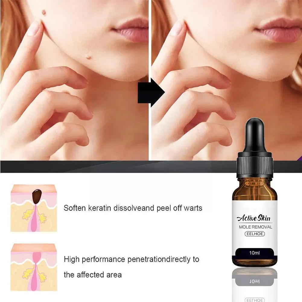 

Removing Against Moles Remover Anti Verruca Remedy Of Removal Liquid Warts Treatment Skin From Tags Essence Papillomas Z2R7