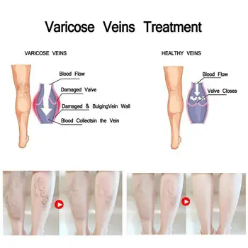 VOVA Varicose Vein Cream Effective Treatment Ointment Beauty Health Vasculitis Medical Chinese Herbal Phlebitis Legs Skin Care 5