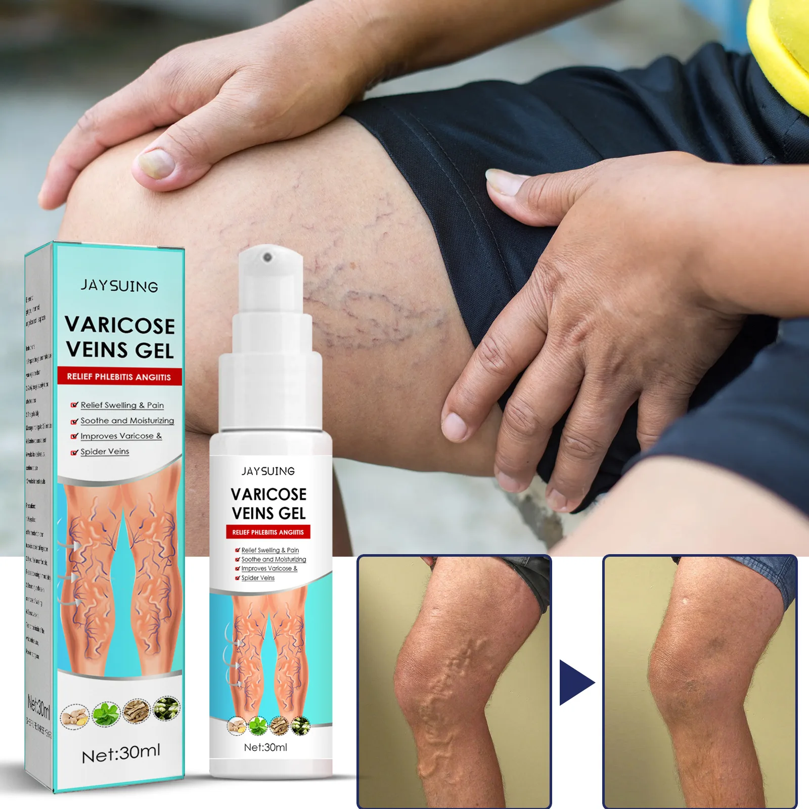 

Varicose Vein Relief Spray Relieve Vasculitis Phlebitis Spider Leg Pain Treatment Ointment Medical Sooth Moisturizing Body Care