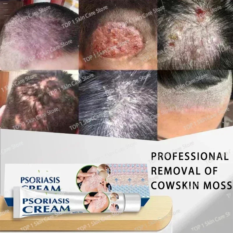 Лидер продаж крем для удаления псориаза экземы лучшие средства против дерматита