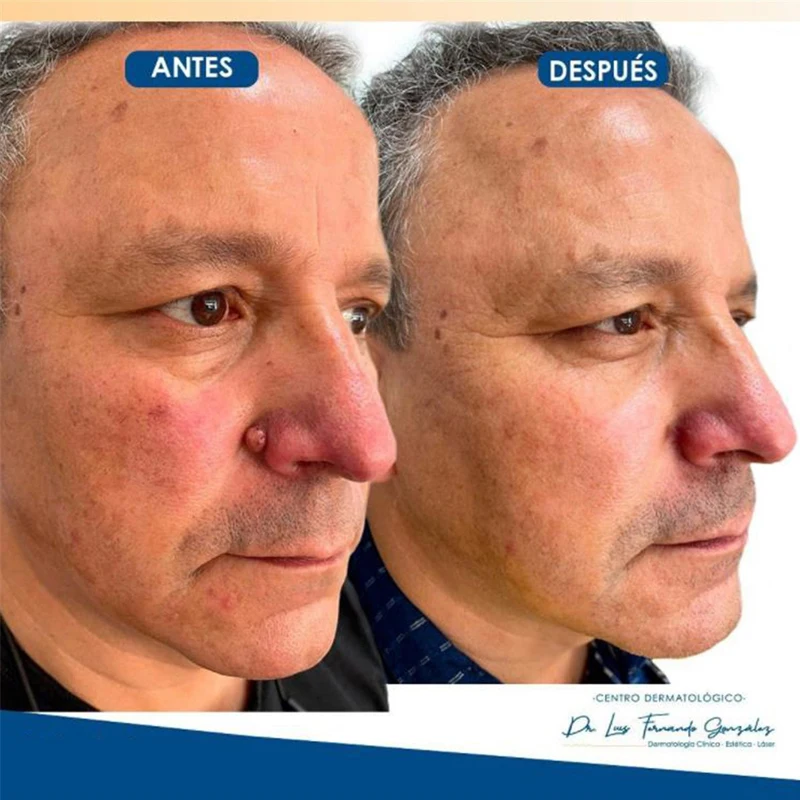 Крем для удаления этикеток на коже безболезненное средство Кротов и темных пятен