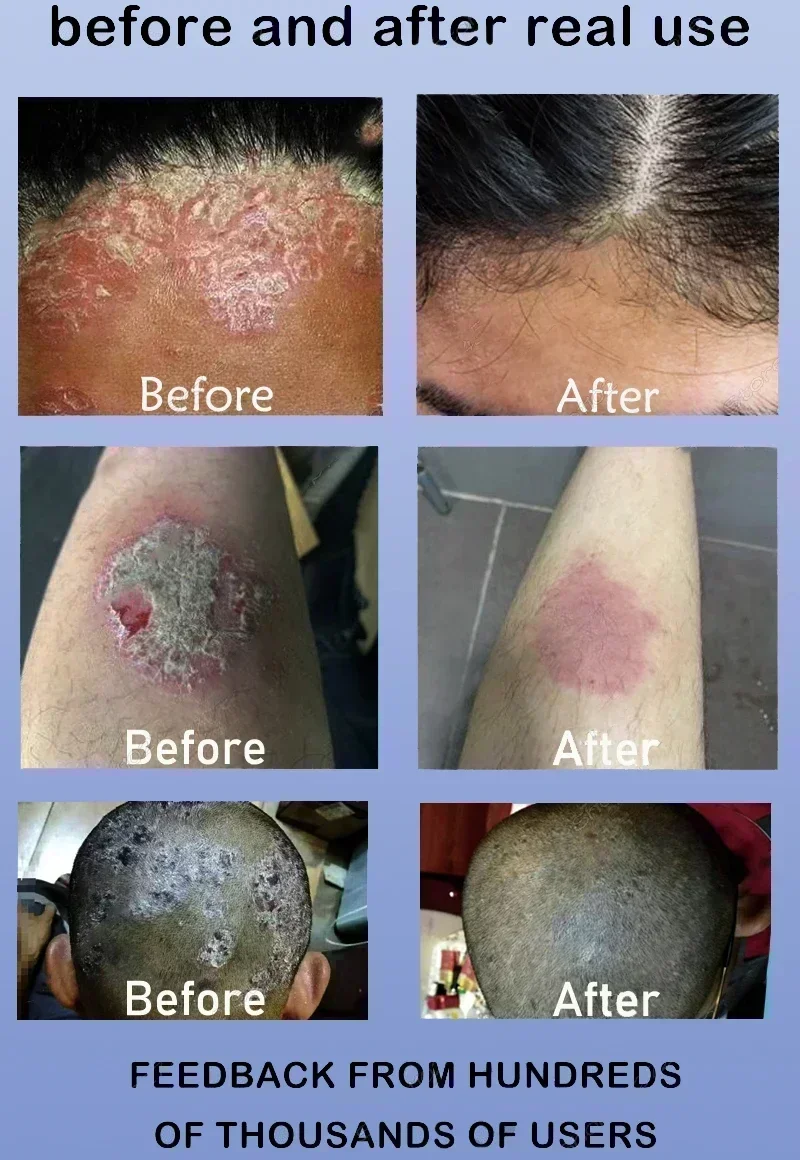 Новый лучший продукт против дерматита при псориазе и экземе Лечение: натуральный