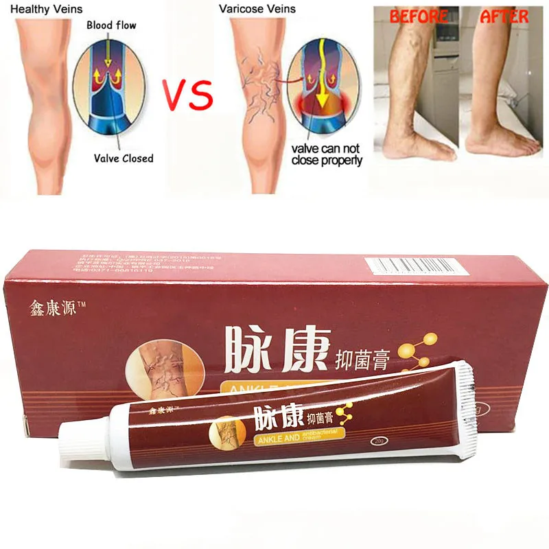 

Китайский травяной крем для лечения варикозного расширения вен, мазь от васкулита, воспаления, массаж ног, пластырь для удаления варикозного расширения вен