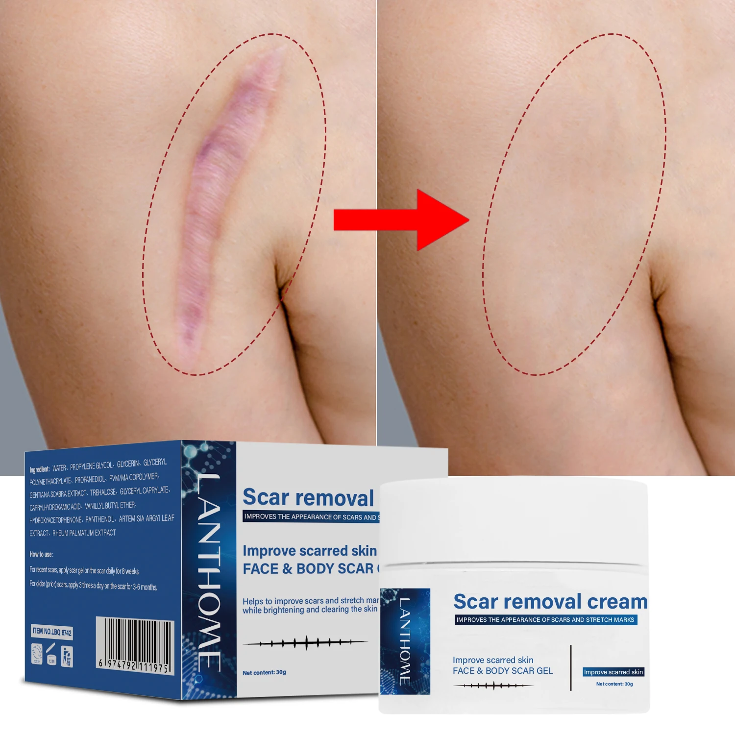 

Травяной крем для удаления шрамов для лечения акне удаление растяжек ремонт ожогов хирургическое средство для удаления шрамов от акне мазь для удаления шрамов