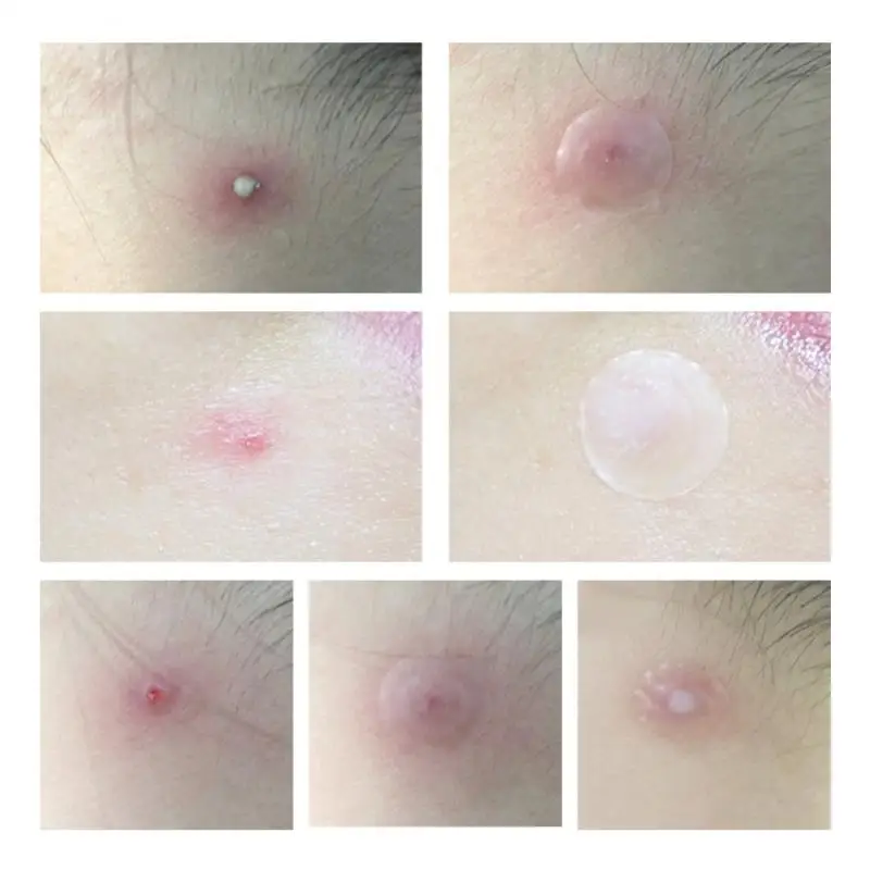 LANBENA Пластырь от прыщей и для ночного использования лечение рубцов акне