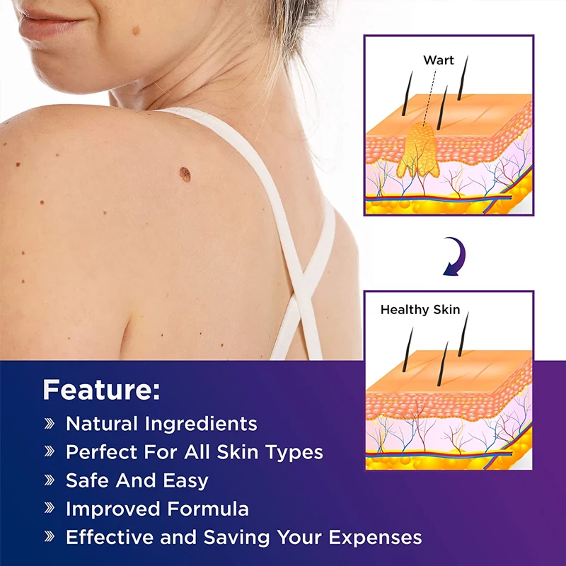 Средство для удаления бородавок с кожей 2022 |