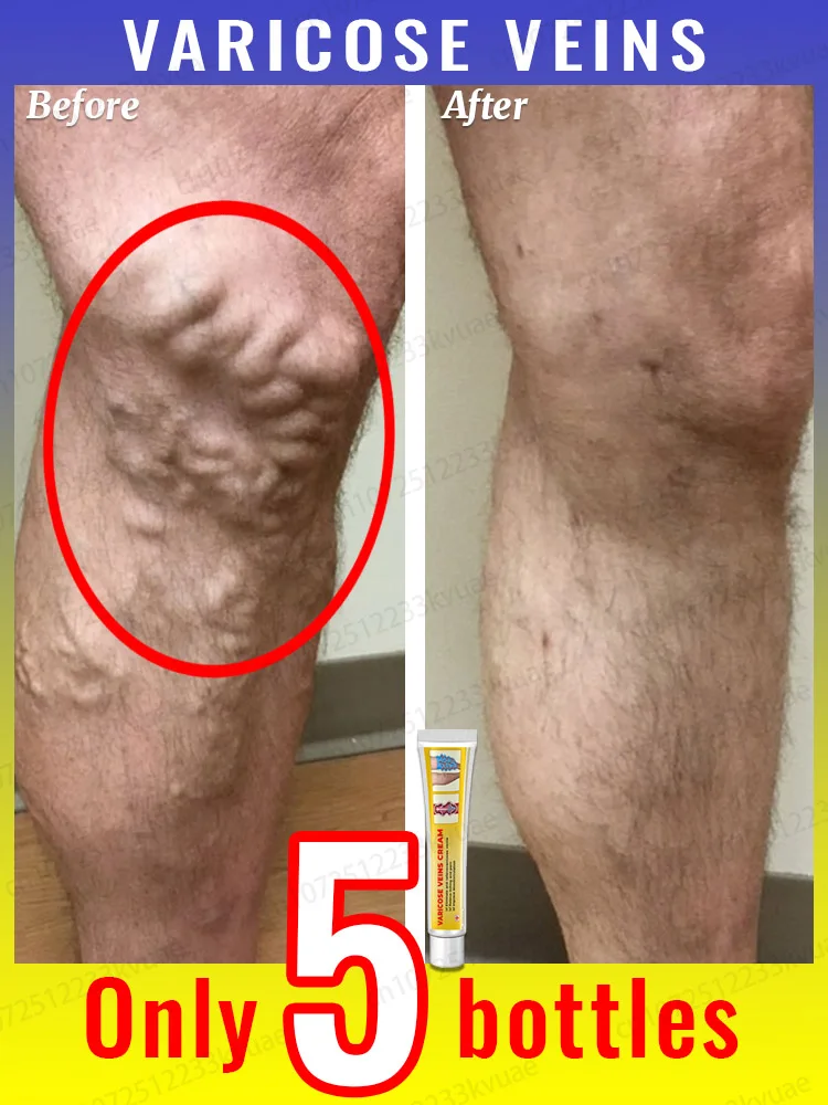 

Ointment for Varicose Veins Eliminate Spider Legs Spider Vein to Relieve Vasculitis Phlebitis Spider Pain Treatment Varicose Vei