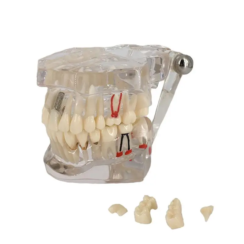 

Dental Implant Disease Teeth Model With Restoration Bridge Tooth Dentist For Medical Science Dental Disease Teaching Study